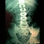 rx-abdomen-cateter-distal-derivacion docencia-pregraduados-facultad de medicina uam- rx-abdomen-cateter-distal-derivacion