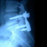 rx-artrodesis-tornillos-transpediculares docencia-pregraduados-facultad de medicina uam- rx-artrodesis-tornillos-transpediculares