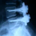 rx-colocacion-tornillos-transpediculares Informacion al paciente-patologia de la columna vertebral-inestabilidad lumbar-rx-colocacion-tornillos-transpediculares
