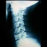 rx-columna-cervical-degeneracion-espacio-c5-c6 docencia-pregraduados-facultad de medicina uam- rx-columna-cervical-degeneracion-espacio-c5-c6