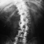 rx-columna-escoliosis-antialgica docencia-pregraduados-facultad de medicina uam- rx-columna-escoliosis-antialgica