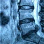 rx-columna-lumbar-disco-herniado docencia-pregraduados-facultad de medicina uam- rx-columna-lumbar-disco-herniado