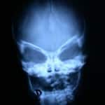 rx-craneal-braquicefalia Información al paciente - neurocirugia pediatrica - RX craneal de una braquicefalia