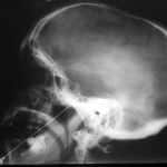 rx-craneal-ganglio-gasser Información al paciente-neurocirugia funcional-neuralgia-del-trigemino-rx-craneal-ganglio-gasser