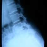 rx-en-flexion Informacion al paciente-patologia de la columna vertebral-inestabilidad lumbar-rx-en-flexion