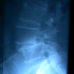 rx-espondilolistesis-l4-l5 docencia-pregraduados-facultad de medicina uam-