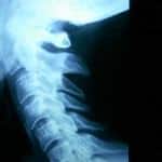 rx-lateral-columna-cervical-fractura-ahorcado docencia-pregraduados-facultad de medicina uam- sección medular- rx-lateral-columna-cervical-fractura-ahorcado