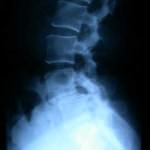 rx-lateral-columna-listesis-l4-l5 Informacion al paciente-patologia de la columna vertebral-inestabilidad lumbar-rx-lateral-columna-listesis-l4-l5