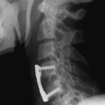 rx-lateral-placa-de-artrodesis docencia-pregraduados-facultad de medicina uam- rx-lateral-placa-de-artrodesis