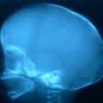 rx-tridimensional-lactante-con-escafocefalia Información al paciente - neurocirugia pediatrica - RX tridimensional de lactante con escafocefalia