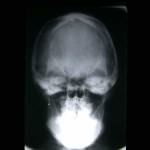 sindrome-de-apert docencia-pregraduados-facultad de medicina uam- Síndrome de Apert