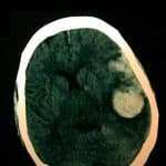 tac-cerebral-con-hematoma-intraparenquimatoso docencia-pregraduados-facultad de medicina uam- tac-cerebral-con-hematoma-intraparenquimatoso