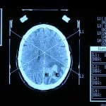 tac-cerebral-guia-estereotaxica docencia-pregraduados-facultad de medicina uam- tac-cerebral-guia-estereotaxica