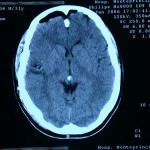 tac-control-tras-extirpar-cavernoma informacion al paciente - neuronavegador -tac-control-tras-extirpar-cavernoma