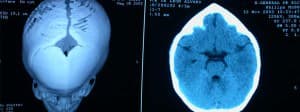 tac-craneal-cierre-sutura-metopica Información al paciente - neurocirugia pediatrica - TAC craneal sutura metopica