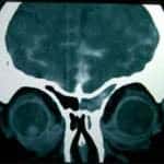 tac-craneal-fistula-lcr docencia-pregraduados-facultad de medicina uam- tac-craneal-fistula-lcr