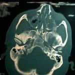 tac-craneal-fractura-base-de-craneo docencia-pregraduados-facultad de medicina uam- tac-craneal-fractura-base-de-craneo