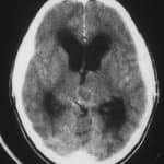 tac-craneal-glandula-pineal-hidrocefalia docencia-pregraduados-facultad de medicina uam- tac-craneal-glandula-pineal-hidrocefalia