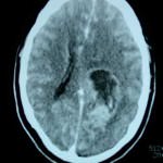 tac-craneal-glioblastoma-multiforme docencia-pregraduados-facultad de medicina uam- tac-craneal-glioblastoma-multiforme