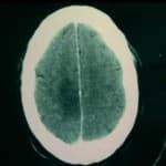 tac-craneal-glioma-bajo-grado docencia-pregraduados-facultad de medicina uam- tac-craneal-glioma-bajo-grado