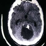 tac-craneal-hemangioblastoma-cerebelo docencia-pregraduados-facultad de medicina uam- tac-craneal-hemangioblastoma-cerebelo