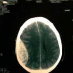 tac-craneal-hematoma-epidural-parietotemporal docencia-pregraduados-facultad de medicina uam- tac-craneal-hematoma-epidural-parietotemporal
