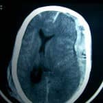 tac-craneal-hematoma-subdural-agudo docencia-pregraduados-facultad de medicina uam- tac-craneal-hematoma-subdural-agudo