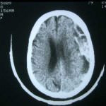 tac-craneal-hematoma-subdural-agudo docencia-pregraduados-facultad de medicina uam- tac-craneal-hematoma-subdural-agudo