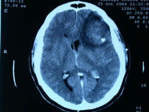 tac-craneal-proceso-expansivo-desplazamiento-linea-media Información al paciente.-Temas generales.-HIC y Edema Cerebral-tac-craneal