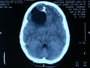 tac-craneal-tumor con calcio-y-quiste informacion al paciente-patologia craneoncefalica-gliomas-tac craneal- con tumor con clacio y quiste