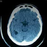 tac craneal-tumor-disembrioplasico docencia-pregraduados-facultad de medicina uam- tac craneal-tumor-disembrioplasico