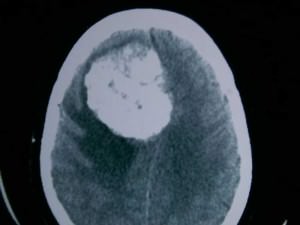 tac-de-craneo-gran-meningioma informacion al paciente -patologia craneoencefalica-meningiomas-tac de craneo con gran meningioma