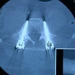 tac-disposicion-tornillos Informacion al paciente-patologia de la columna vertebral-inestabilidad lumbar-tac-disposicion-tornillos