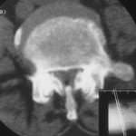 tac-lumbar-estenosis-de-canal docencia-pregraduados-facultad de medicina uam- tac-lumbar-estenosis-de-canal