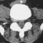 tac-lumbar-hernia-discal-foraminal docencia-pregraduados-facultad de medicina uam- tac-lumbar-hernia-discal-foraminal