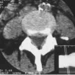 tac-lumbar-hernia-discal-medial docencia-pregraduados-facultad de medicina uam- tac-lumbar-hernia-discal-medial