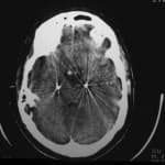 tac-pre-quirurgico-epilepsia informacion al paciente - cirugia funcional - cirugia de la epilepsia - tac-pre-quirurgico-epilepsia