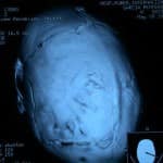 tac-tridimensional-lactante-con-escafocefalia Información al paciente - neurocirugia pediatrica - tac tridimensional de un lactante con escafocefalia