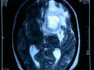 tumor-con-componente-quistico informacion al paciente-patologia craneoncefalica-gliomas-tumor-componete quistico