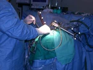 utilizacion-neuronavegador-en-quirofano informacion al paciente - neuronavegador -utilizacion-neuronavegador-en-quirofano
