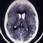 02-hemorragia-producida-por-aneurisma información al paciente-patologia craneoencefalica-aneurismas y otras malformaciones vasculares-hemorragia-producida-por-aneurisma