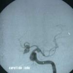05-angiografia información al paciente-patologia craneoencefalica-aneurismas y otras malformaciones vasculares-angiografia