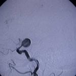 12A-tecnica-de-embolizacion-por-coils información al paciente-patologia craneoencefalica-aneurismas y otras malformaciones vasculares-tecnica-de-embolizacion-por-coils
