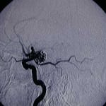 12B-tecnica-de-embolizacion-por-coils información al paciente-patologia craneoencefalica-aneurismas y otras malformaciones vasculares-imagen coils