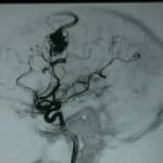 13-imagen-malformacion-arteriovenosa información al paciente-patologia craneoencefalica-aneurismas y otras malformaciones vasculares-imagen-malformacion-arteriovenosa