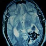 15-RM-relacion-mav-parenquima-cerebral información al paciente-patologia craneoencefalica-aneurismas y otras malformaciones vasculares-RM-relacion-mav-parenquima-cerebral
