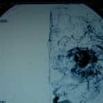 18-arteriografia información al paciente-patologia craneoencefalica-aneurismas y otras malformaciones vasculares-arteriografia