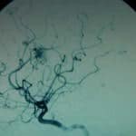 19-escala-spetzler-martin-tratamiento-endovascular información al paciente-patologia craneoencefalica-aneurismas y otras malformaciones vasculares-escala-spetzler-martin-tratamiento-endovascular