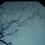 21B-tecnicas-endovasculares