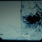 21C-tecnicas-endovasculares